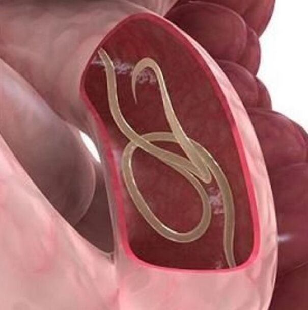 Segni di vermi in una persona nel tratto gastrointestinale